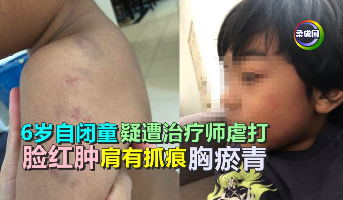 6岁自闭男童疑遭治疗师虐打   脸红肿   肩有抓痕  被捏胸