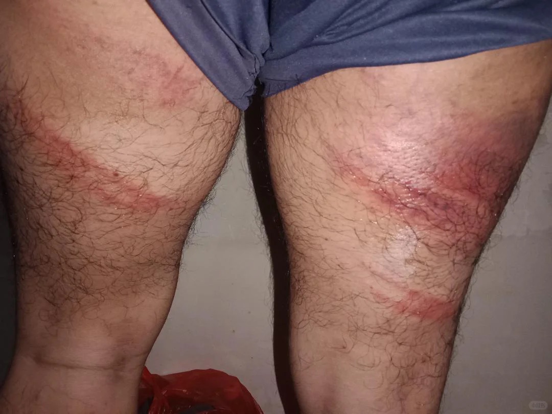 ■“大番薯”被电击双腿灼伤，但这伤势被指是较轻惩的，有的人伤得更重。