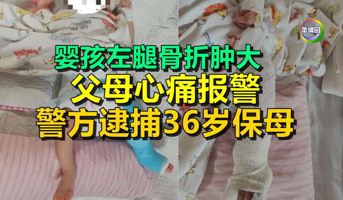 婴孩左腿骨折肿大  父母心痛报警  警方逮捕36岁保母