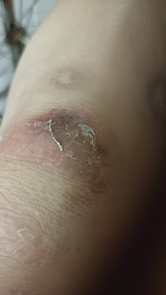 ■塑型袜旧了，以致翁秀春的脚被义肢磨擦受伤。