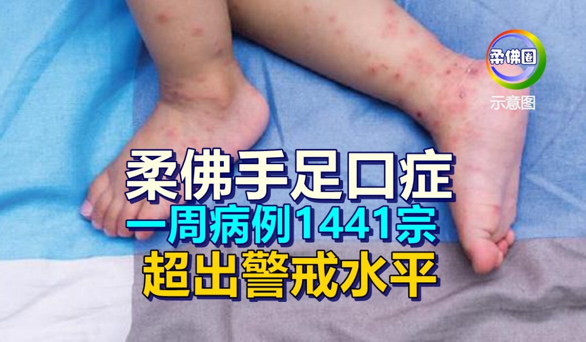 柔佛手足口症  一周病例1441宗   超出警戒水平